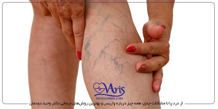 از درد پا تا مشکلات جدی: همه چیز درباره واریس و بهترین روشهای درمانی دکتر وحید دودمان
